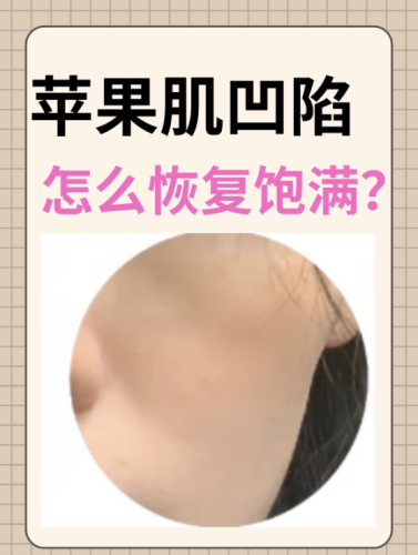臉部凹陷怎么自然恢復飽滿？?這些 “填充術” 藏在生活里