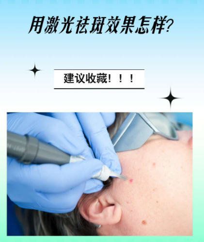 激光去斑有效嗎？從斑點(diǎn)類型看 “光與色素的對(duì)抗結(jié)果”