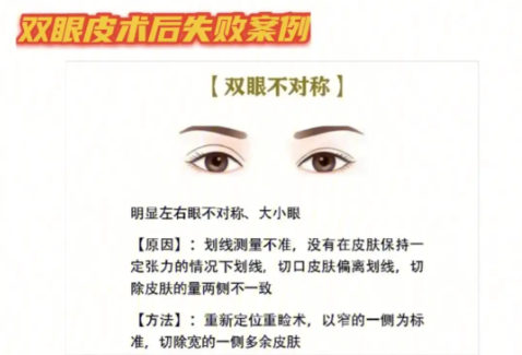 長沙雙眼皮修復專家排名，專治各種雙眼皮翻車現(xiàn)場