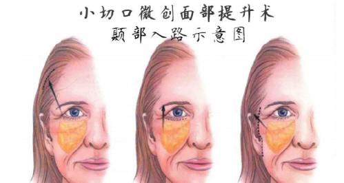 顳部提升手術(shù)的弊端有哪些？ “繃緊的弦” 藏著隱患