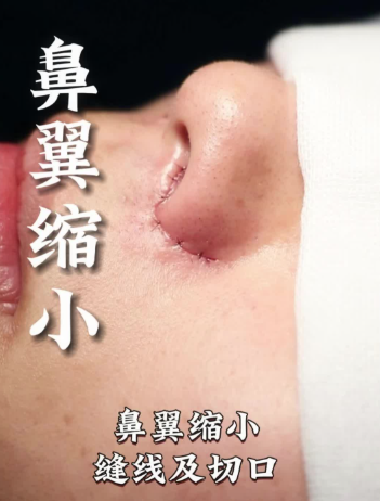 鼻翼縮小切口多久愈合？看這些 “傷口變美記” 就知道