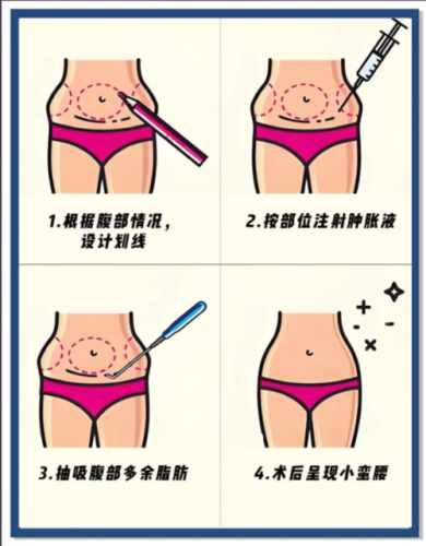 武漢做腰腹環(huán)吸比較好的醫(yī)院，看看哪家更合心意？