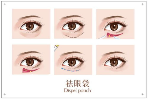 割眼袋算小手術(shù)嗎？有的輕松有的麻煩