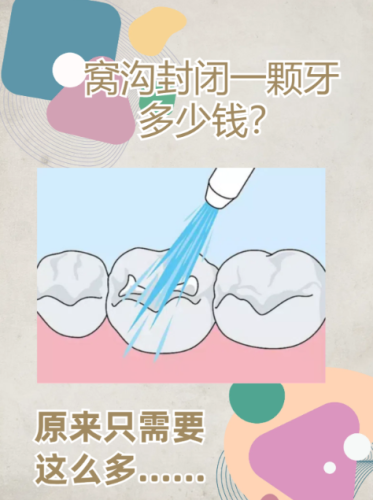 窩溝封閉價(jià)格是多少？為您解析費(fèi)用構(gòu)成及影響因素