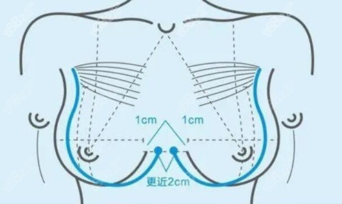 上海哪個(gè)醫(yī)院做胸部整形不知道選？看完這篇就有數(shù)！