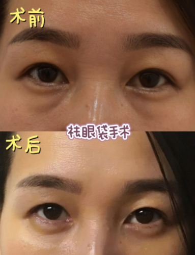 北京哪里做眼袋比較好？綜合實(shí)力突出醫(yī)院一覽表