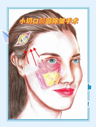 小切口除皺術(shù)的危害有哪些？真的安全嗎？