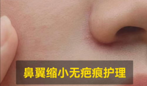 鼻翼縮小內(nèi)切口多久愈合？術(shù)后恢復(fù)進(jìn)程與注意事項(xiàng)詳解