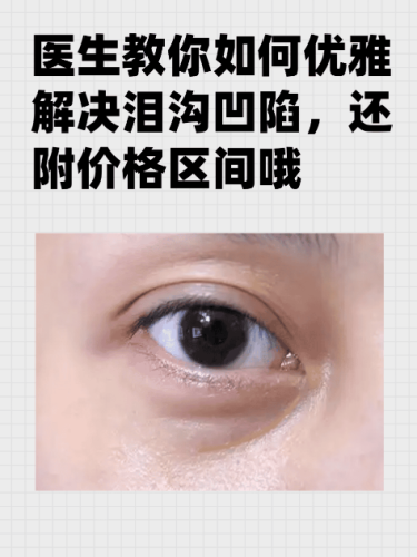 淚溝凹陷怎么解決好？不同情況給出針對性選擇建議