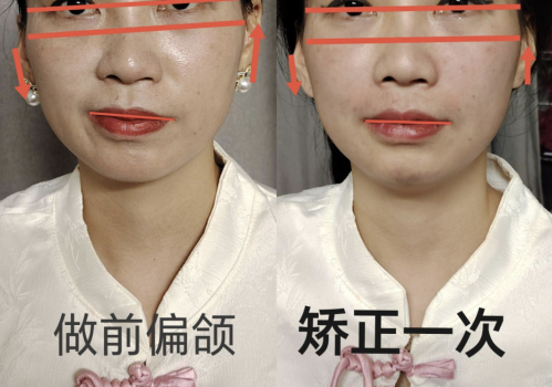 下頜骨不對稱整形效果能維持多久？風險大不大？