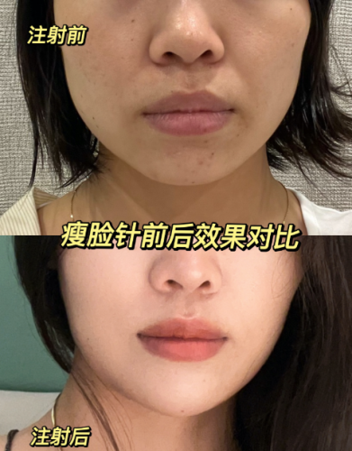 蘇州哪家整形醫(yī)院打瘦臉針好？效果測評直接抄作業(yè)！