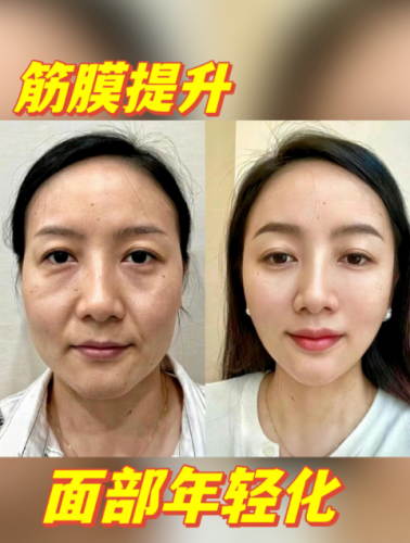 北京筋膜提升醫(yī)院排名，你pick的醫(yī)院在里面嗎？