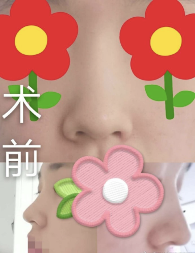 杭州劉中策做鼻子怎么樣？技術(shù)水平和口碑表現(xiàn)如何？