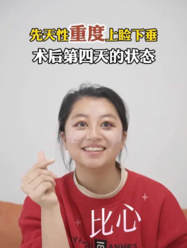 先天性上臉下垂是什么原因造成的？可以手術(shù)矯正嗎？