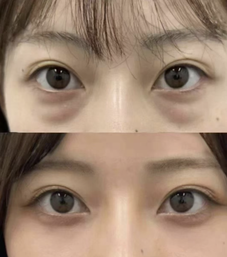 沈陽杏林眼袋做的好的醫(yī)生是誰？好口碑都在這里