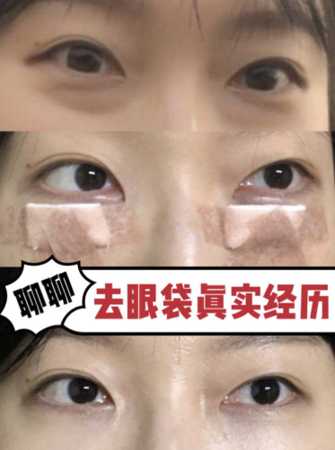 寧波去眼袋的正規(guī)醫(yī)院：天花板級(jí)別的機(jī)構(gòu)推薦