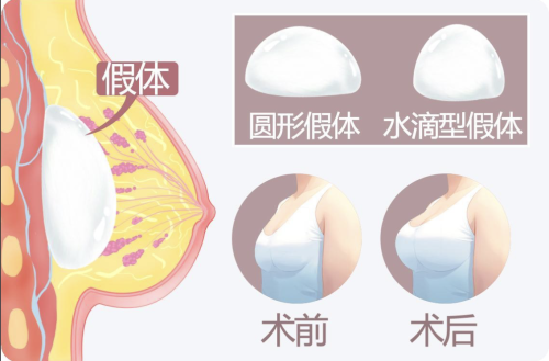 南京假體隆胸排行榜：必看 TOP 榜！速碼！