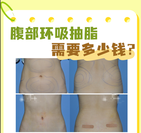 武漢腰腹環(huán)吸多少錢？?jī)r(jià)格圖譜與機(jī)構(gòu)甄選指南都在這