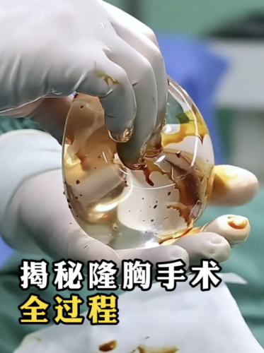 江門(mén)中心醫(yī)院豐胸手術(shù)怎么樣？手術(shù)體驗(yàn)實(shí)錄