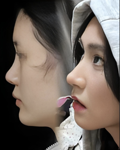 北京醫(yī)院隆鼻怎么樣？從就診到恢復(fù)的真實(shí)體驗(yàn)