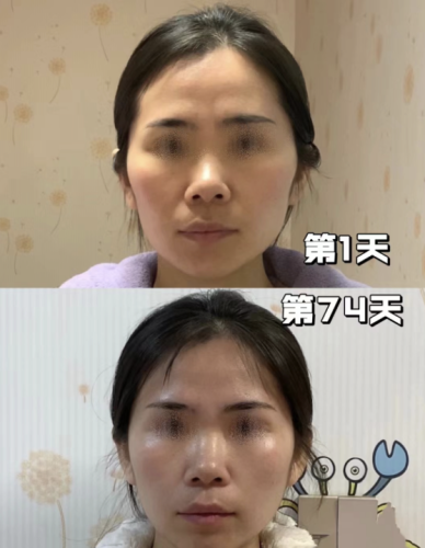 顴骨內(nèi)推手術(shù)風(fēng)險(xiǎn)高嗎？到底有多離譜？