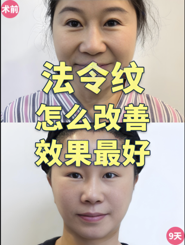 填法令紋用什么好？哪種材料更合適？