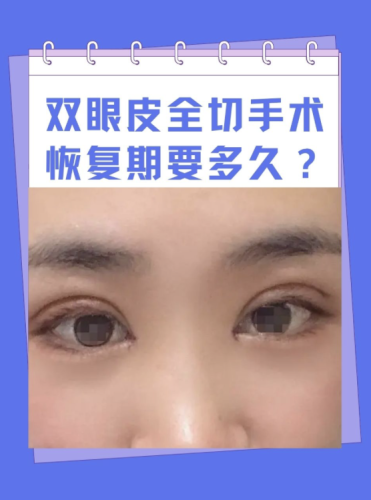 割雙眼皮多久能恢復(fù)正常