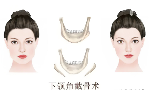 切下頜角多久恢復(fù)？展開說(shuō)說(shuō)