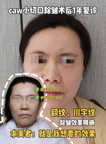 煙臺(tái)煙臺(tái)山醫(yī)院除皺手術(shù)怎么樣？直接看價(jià)格表，主打一個(gè)明明白白消費(fèi)！
