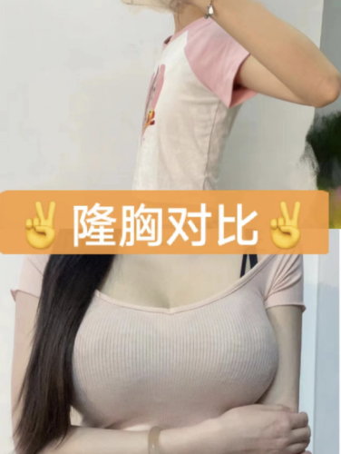 宿州市立醫(yī)院隆胸多少錢(qián)？花了3萬(wàn)術(shù)后驚艷全場(chǎng)