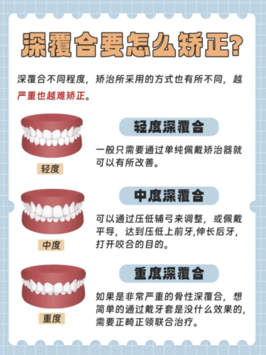 深覆合怎么矯正？今天這篇干貨直接給你整明白！
