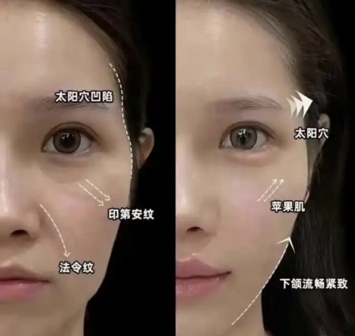 面部填充哪種安全？找對(duì)醫(yī)院找對(duì)人，風(fēng)險(xiǎn)可控