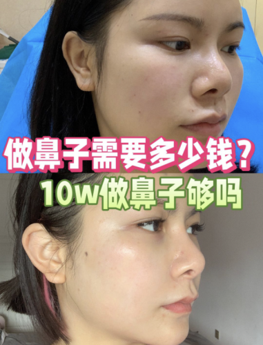 常州第七人民醫(yī)院做鼻子多少錢？10w夠嗎
