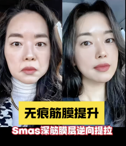 做了面吸多久可以做筋膜提升？3-6個(gè)月比較適宜