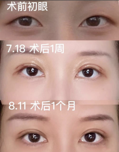 貴州醫(yī)科大學附屬醫(yī)院割雙眼皮多少錢？手術(shù)方式不同，價格差別大
