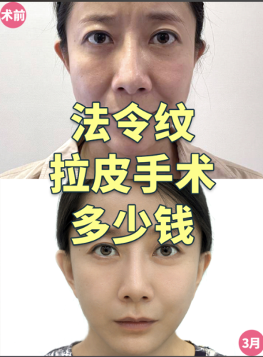 包頭中心醫(yī)院拉皮除皺多少錢？找對(duì)醫(yī)生、選對(duì)方案，別花冤枉錢