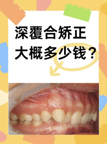 深覆合矯正需要多少錢？一文讀懂費用背后的秘密