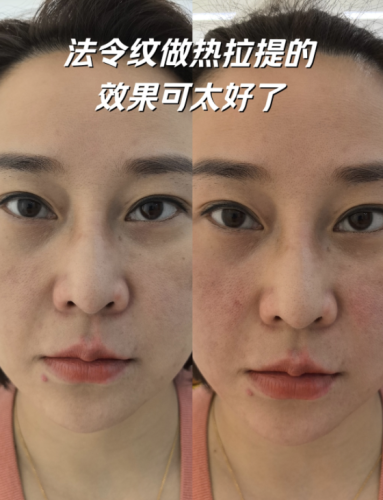 法令紋做什么醫(yī)美項目比較好？各種去紋大招都有！速來圍觀！
