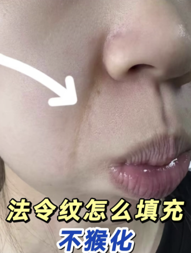 填法令紋后遺癥什么材料好？材料選擇與后遺癥剖析