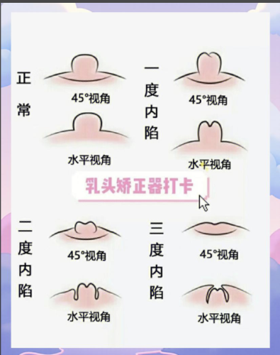 乳頭內(nèi)陷矯正術(shù)怎么做？看看哪種方式適合你？