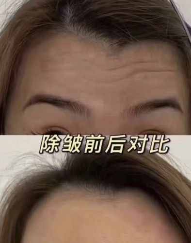 菏澤中醫(yī)醫(yī)院拉皮除皺多少錢？材料選擇有講究