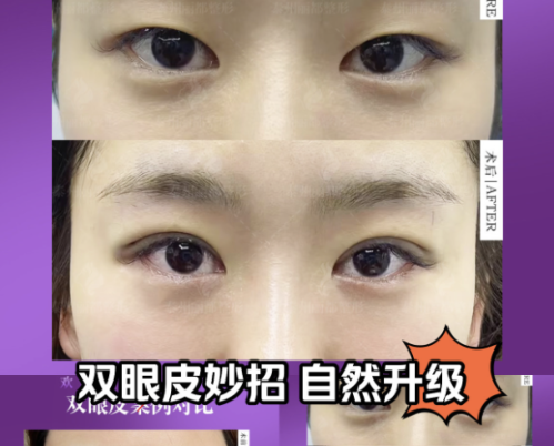 漳州第三醫(yī)院割雙眼皮多少錢？雙眼皮價格總覽