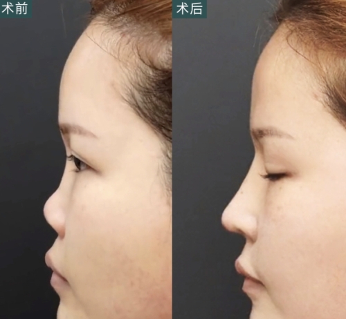 貴州醫(yī)科大學(xué)附屬醫(yī)院隆鼻怎么樣？總有一款適合你