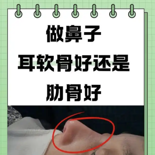 做鼻子用耳軟骨還是肋骨做效果好？從不同角度嘮一嘮