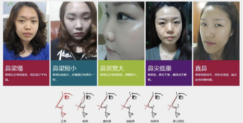 北京航天總醫(yī)院做鼻子多少錢？這些方面都會影響手術(shù)的定價