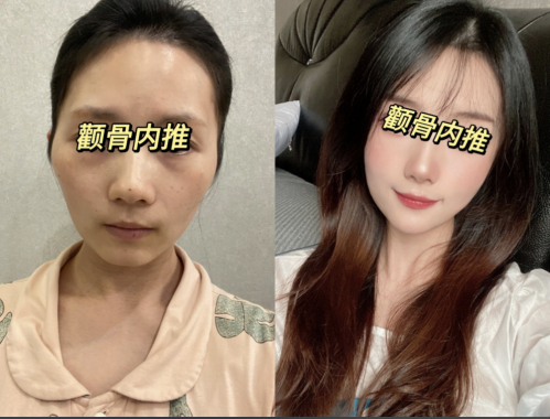 顴骨內(nèi)推是怎么做的？改變臉型、提升顏值的絕美選擇
