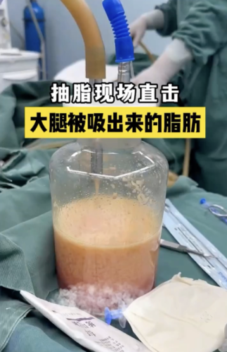 大石橋中心醫(yī)院抽脂好嗎？價(jià)格又是怎樣的呢？接下來為你詳細(xì)揭秘