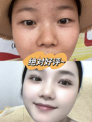 北京空軍特色醫(yī)學(xué)中心割雙眼皮多少錢？給寶子們整了份“懶人價目表”