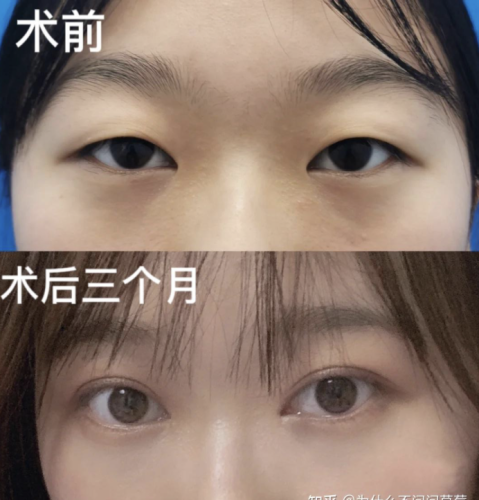 成都中西醫(yī)結(jié)合醫(yī)院割雙眼皮多少錢？扒一扒雙眼皮的真實(shí)價(jià)位