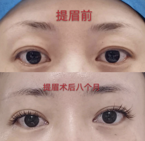 提眉術(shù)多久可以恢復(fù)自然？術(shù)后1個(gè)月左右就可以